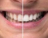 Teeth Whitening
